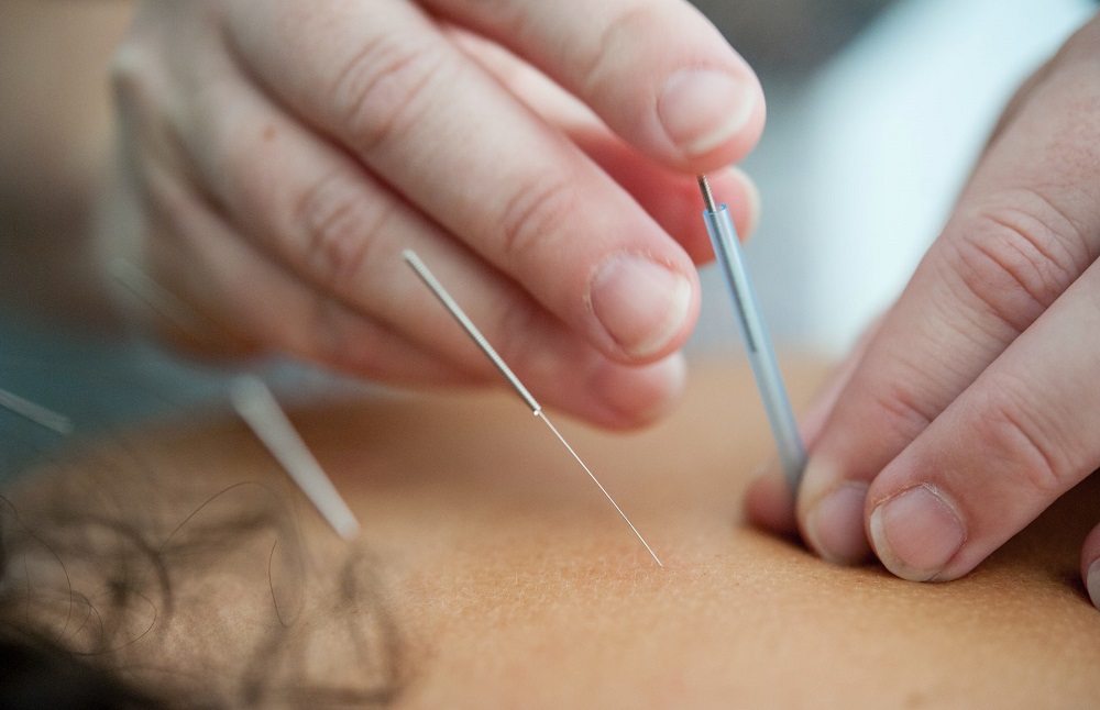 Dry Needling  Greenville, SC 
